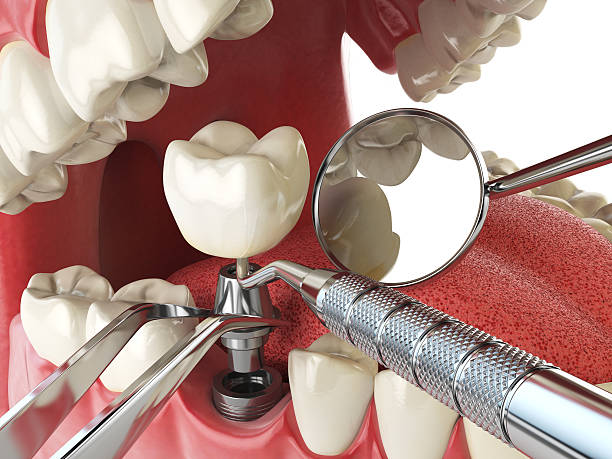 Best Emergency Root Canal Treatment in Mona, UT